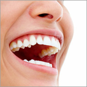 Zahnaufhellung schönes Lachen