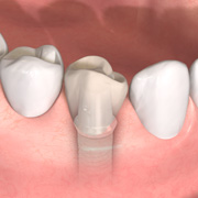 Implantologie Bergheim Zahnarzt
