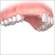 Implantat ersetzt Zahn Wurzel