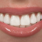 Veneers perfektes Lächeln