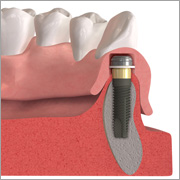 Zahnersatz Implantat